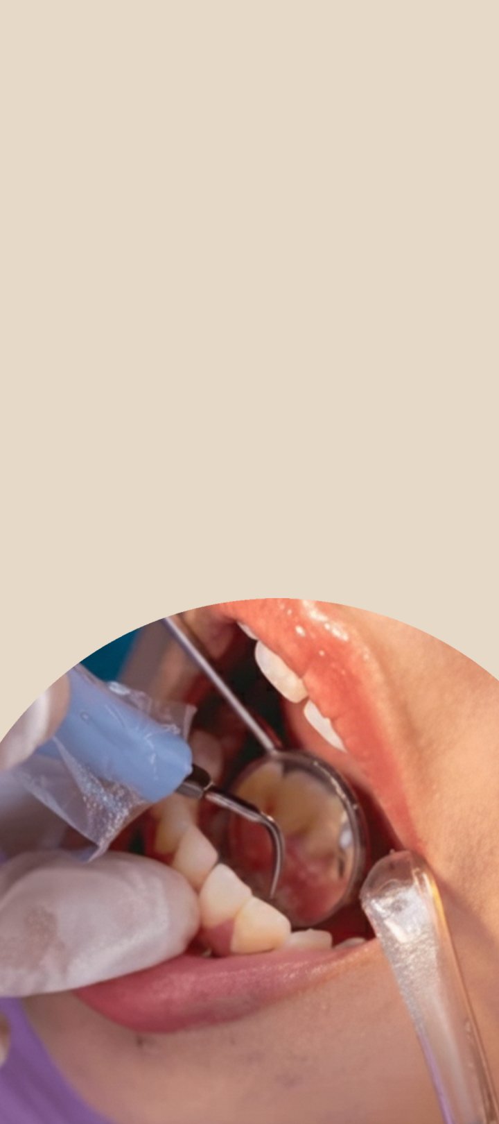 Layanan Scaling Gigi